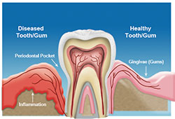 Gum disease